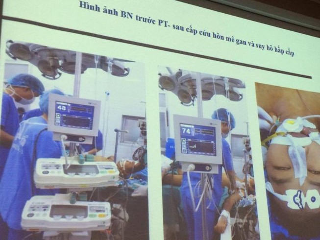 Ghép gan cứu sống bệnh nhân đã tiên lượng 90% tử vong