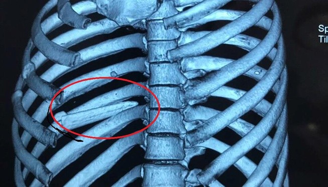 Cứu sống một người bị đâm thấu phổi bằng mũi cá kiếm