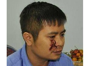 Đăng kiểm viên bị khách đánh rách mí mắt