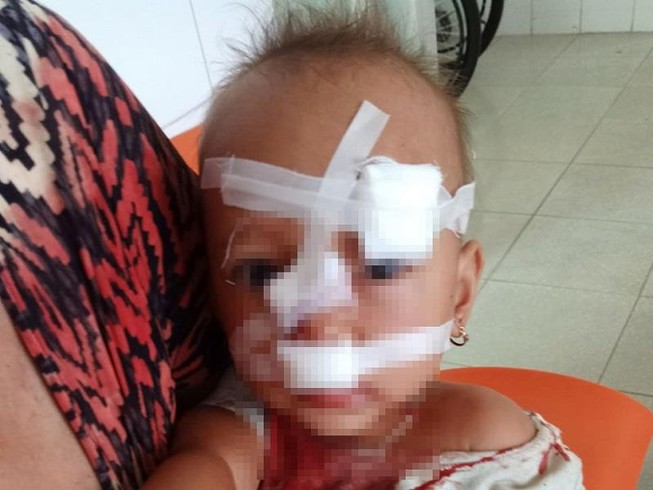 Cha mẹ cãi nhau, bé gái hai tuổi nhập viện khâu 12 mũi