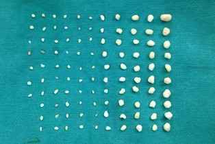 107 viên sỏi trong khớp vai một nữ công nhân