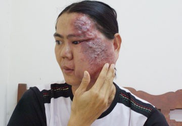 Khổ trăm đường vì khối u quái ác