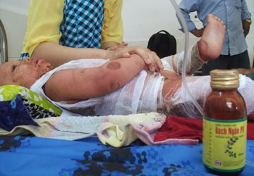 Phú Yên: Dị ứng thuốc, một cháu bé nguy kịch