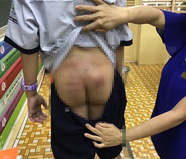 UBND phường 15, quận 11 thông báo vụ nghi bé trai bị bạo hành