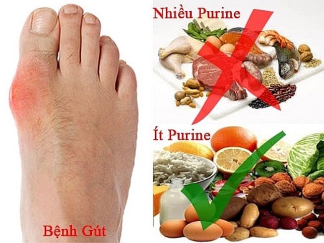 Bị gout, kiêng cữ ăn uống trong ngày Tết ra sao?