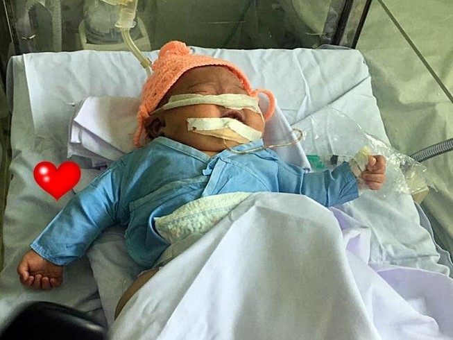 Hội chẩn toàn viện bé gái gãy tay, ngạt thở khi sinh