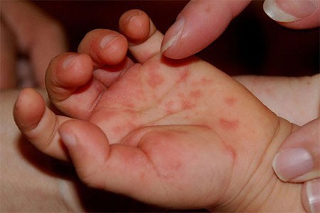 Kiến thức để đối phó bệnh tay chân miệng