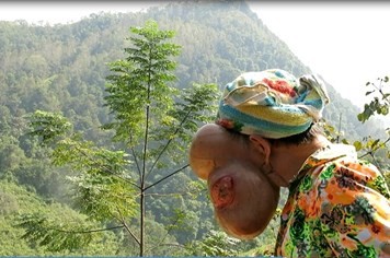 Nữ bệnh nhân mang khối u 3 kg trên mặt về Hà Nội chữa bệnh