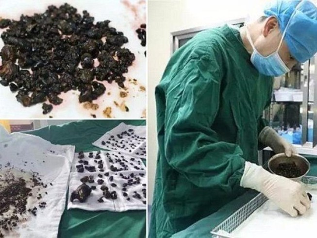 Kinh hoàng phát hiện 200 viên sỏi trong cơ thể