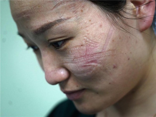 Vết khẩu trang hằn trên mặt một y tá đang chống dịch tại Vũ Hán. Ảnh: CHINA DAILY