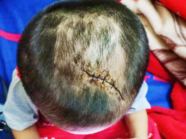 Bé 3 tuổi nghi bị cha dượng bạo hành