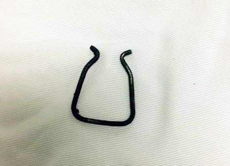 Mổ nội soi lấy kẹp giấy trong lồng ngực bé 26 tháng tuổi