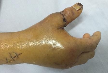 Nối thành công ngón tay cái đứt lìa, rút gân 20 cm