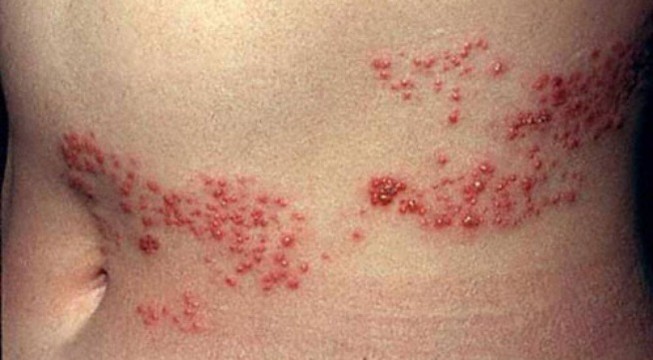 Lựa chọn các thuốc điều trị đau thần kinh sau zona