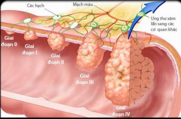 Dấu hiệu vàng cảnh báo sớm bệnh ung thư đại trực tràng