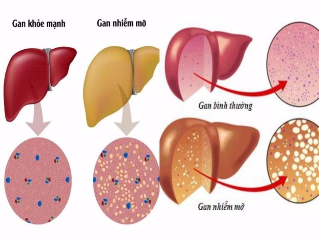 Gan nhiễm mỡ nguy hiểm như thế nào?
