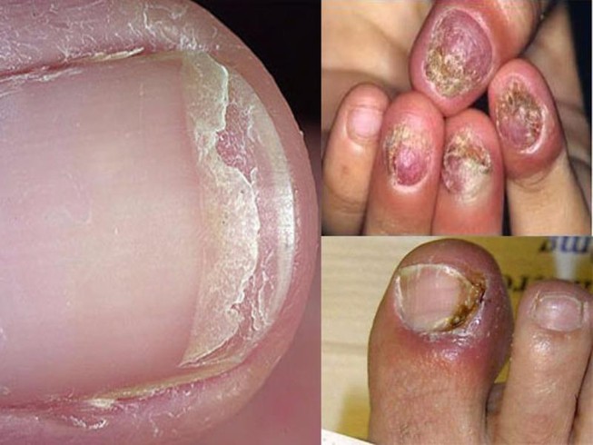 Cần kiên trì khi trị nấm móng