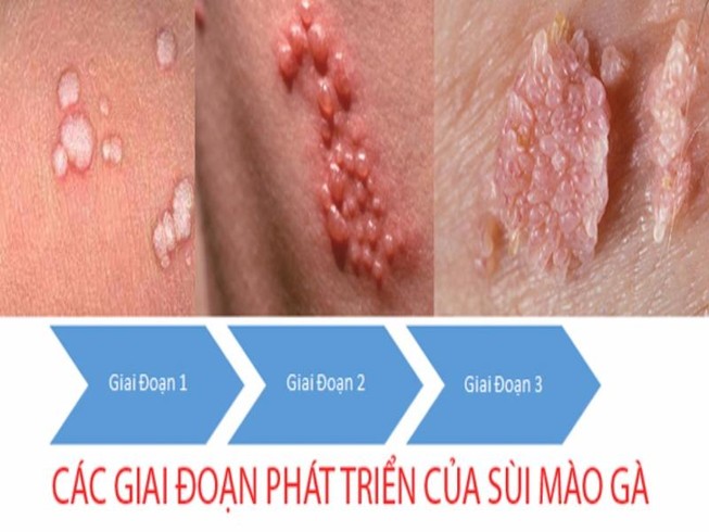Tại sao trẻ em lại mắc sùi mào gà?