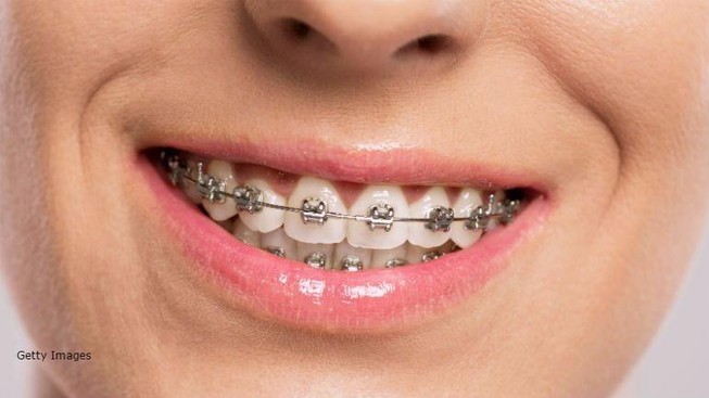 Nuốt dây niềng răng vào bụng suốt 10 năm mà không biết