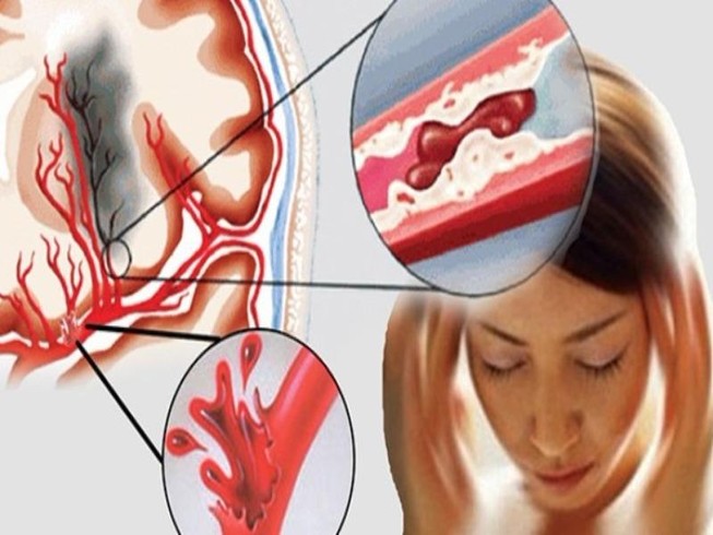 Tại sao trời lạnh dễ bị đột quỵ?