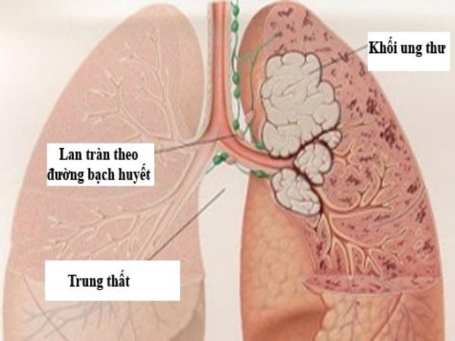 Những dấu hiệu 'tố' bệnh ung thư phổi