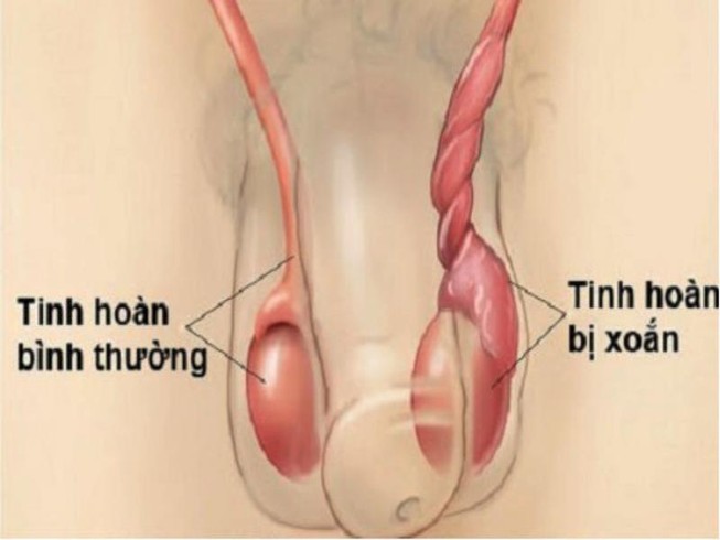 Tinh hoàn bình thường và tinh hoàn bị xoắn. (Ảnh minh họa)