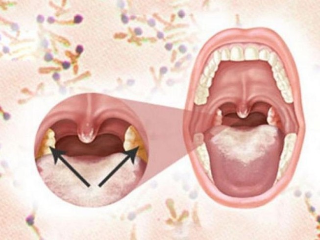 Những biến chứng nguy hiểm của bệnh bạch hầu