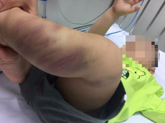 Tìm được người bỏ rơi bé trai 1 tuổi bị bạo hành dã man