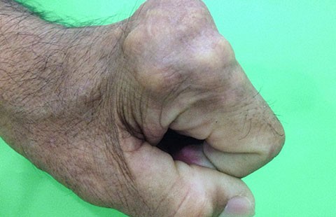 Gout - kẻ ‘giết người’ thầm lặng