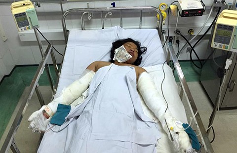 Bé gái bị mẹ đốt đang nguy kịch