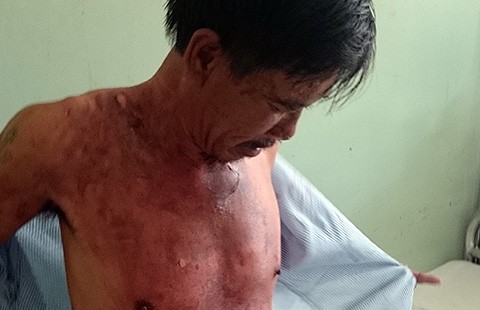 Bị đánh, vợ tạt cháo nóng vào chồng