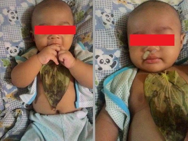 Gây hại con trẻ vì tin vào bài thuốc dân gian