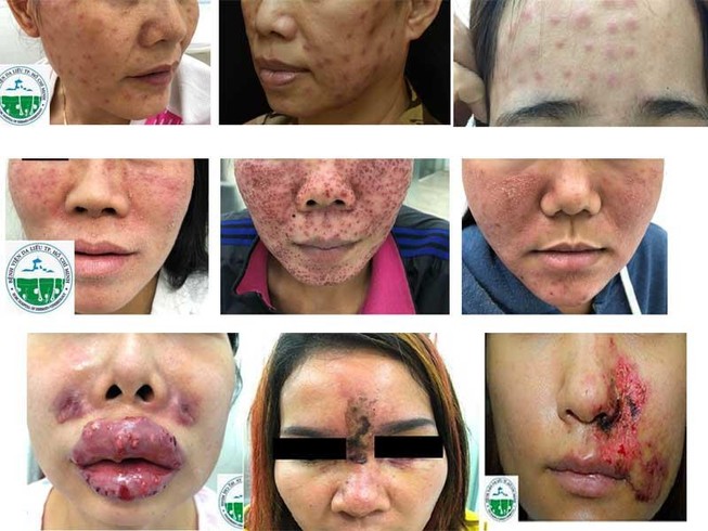 Tàn phá dung nhan vì tiêm, cấy chất trẻ hóa da