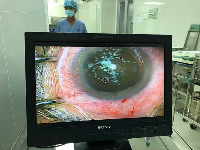 Nguy cơ mù mắt vì tia laser điều trị thẩm mỹ da