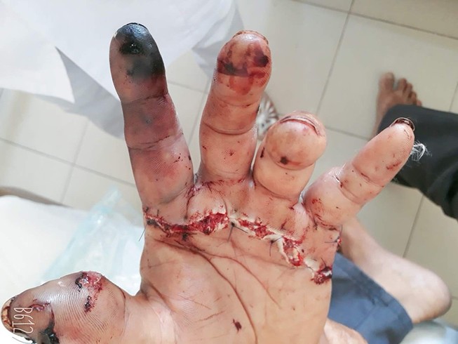 Khánh Hòa: Nối thành công bàn tay bị đứt lìa