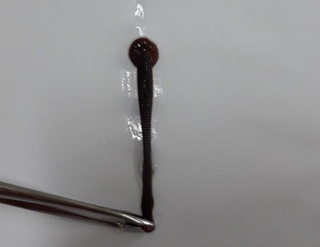 Chảy máu mũi 10 ngày, đến BV được bác sĩ gắp ra con đỉa