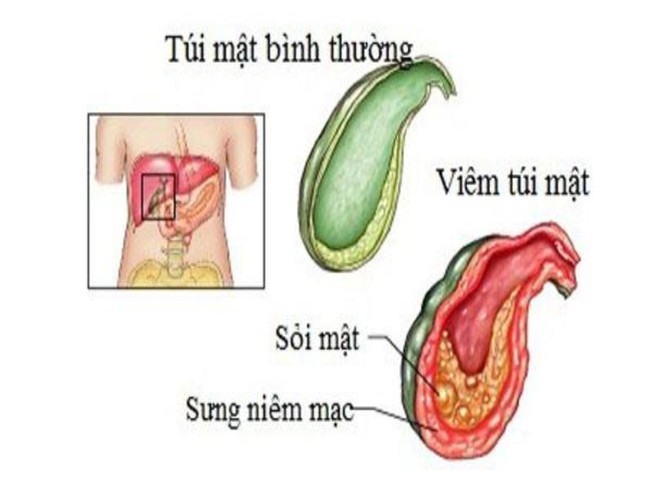 Viem Tui Mật Nguyen Nhan Biểu Hiện Biến Chứng Va Cach điều Trị