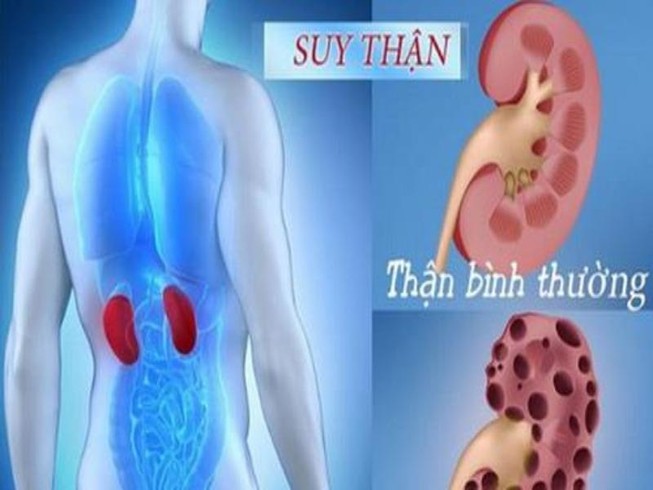 Những điều cần biết về bệnh suy thận mạn tính