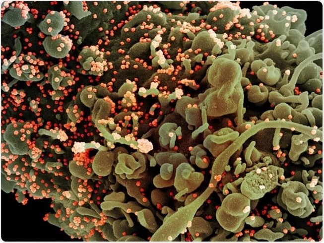 Ảnh quét màu của một tế bào bị nhiễm các hạt virus SARS-CoV-2 trình chiếu trên máy tính.