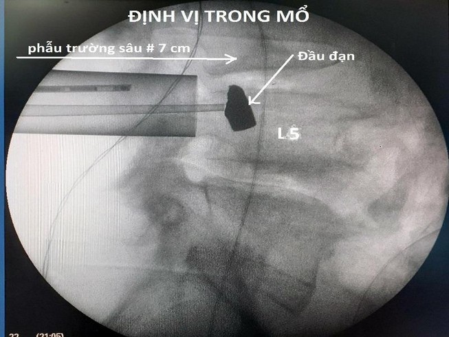Lấy thành công đầu đạn 51 năm nằm trong cơ thể