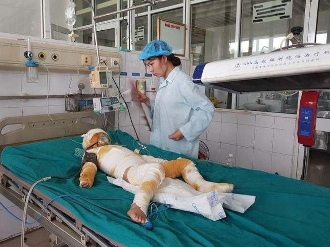 Sức khỏe 3 trẻ bị bỏng nặng vụ cô giáo dùng cồn dạy PCCC