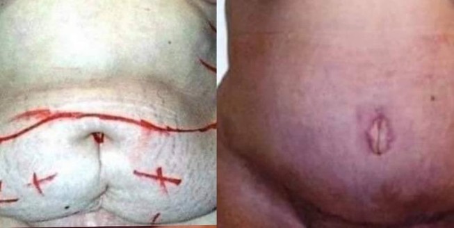 Gần 4 tiếng hút mỡ ra khỏi người phụ nữ bị 'béo phì'