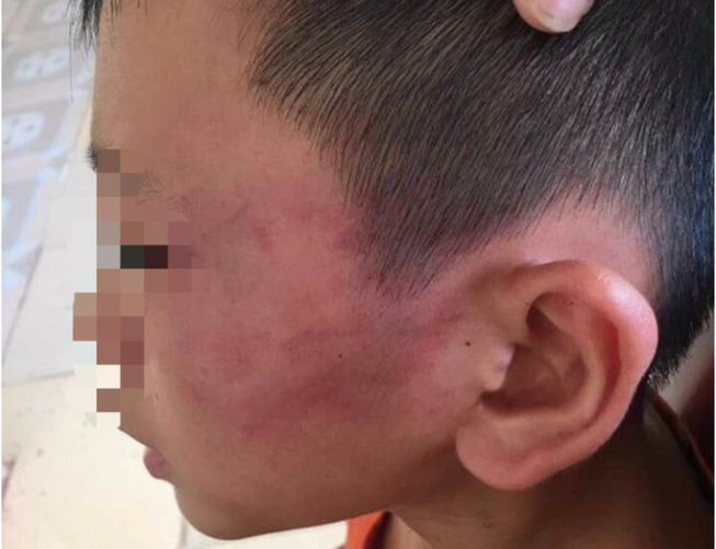 Giám định thương tật cháu bé bị mẹ kế tát bầm tím