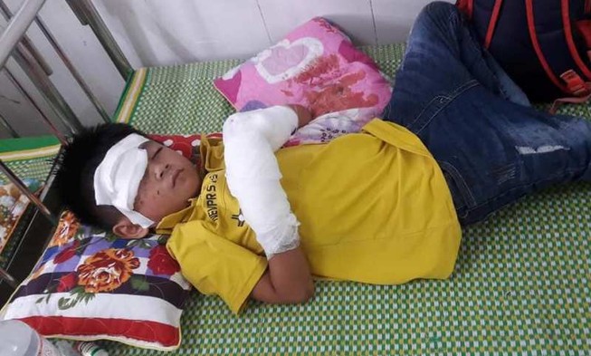 Điện thoại phát nổ, bé 7 tuổi dập nát bàn tay