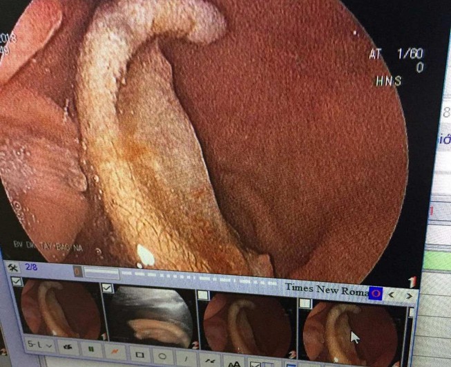 Nội soi lấy phần tai bị cắt đứt trong bụng một học sinh