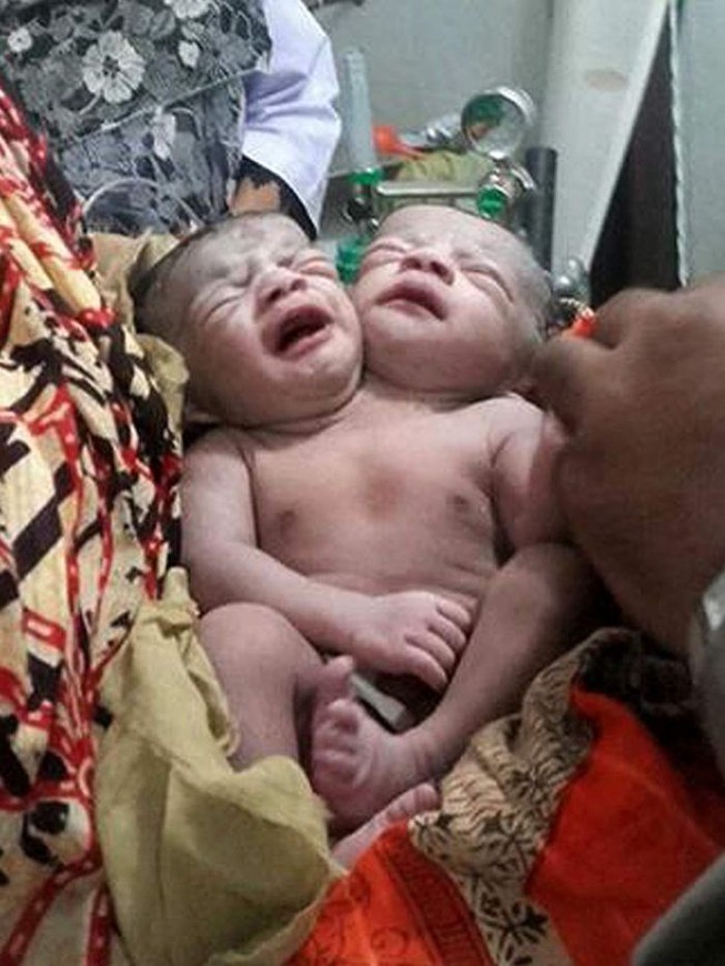 Đứa trẻ hai đầu được sinh ra ở Bangladesh