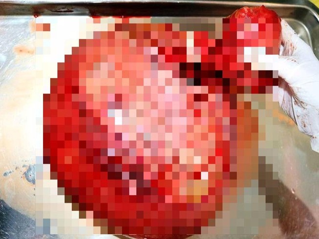 Tự uống thuốc, để khối u xơ nặng tới 4kg