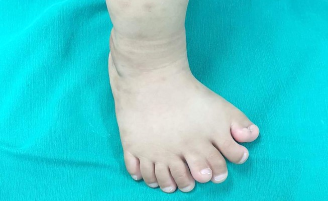 Hy hữu: Bé trai Thanh Hóa có 9 ngón trên 1 bàn chân