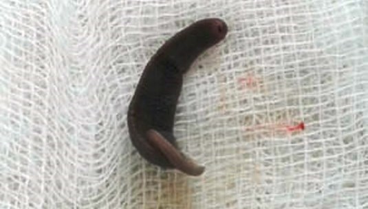Con vắt dài 4cm sống hơn 10 ngày trong mũi bệnh nhi ở Hà Giang