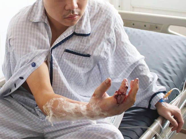 Sơ suất, thanh niên bị máy xay thịt cắt lìa ngón tay